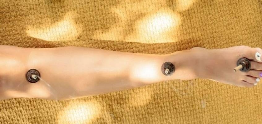 Прижигаются специальные точки Специальные сигары на ноге