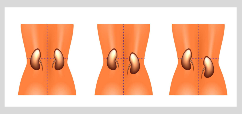 опущение почки