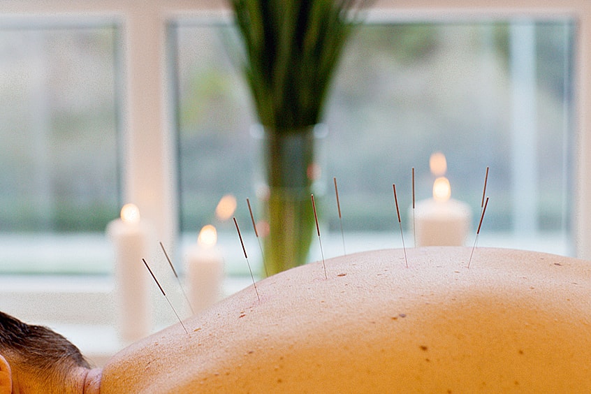 Рефлексотерапия тоже поможет Иглоукалывание