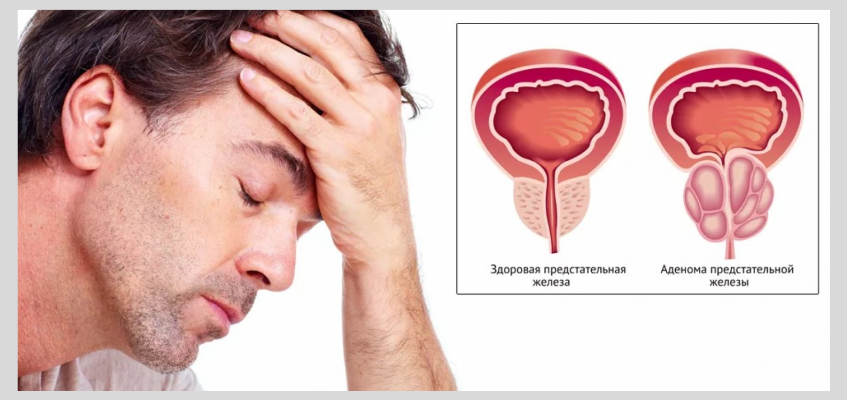 аденома простаты у мужчин