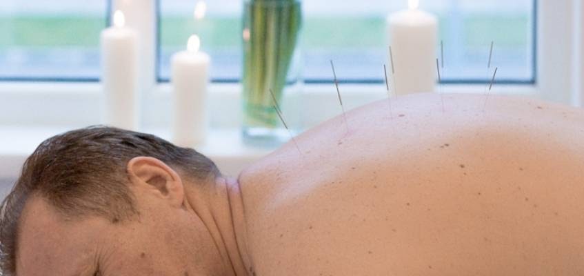 Иглоукалывание проходит в комфортном положении Мужчина с иглами в спине лежит