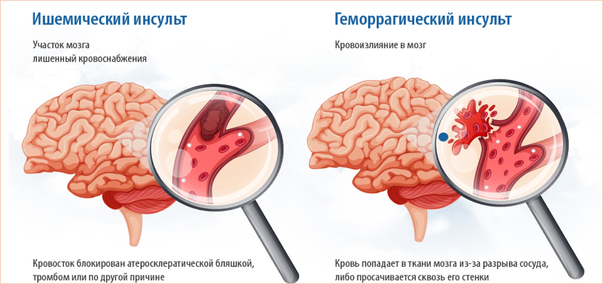 инсульт лечение и реабилитация