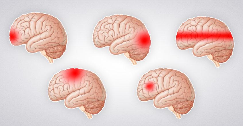 Найдите зону болевых ощущений в голове Головной мозг