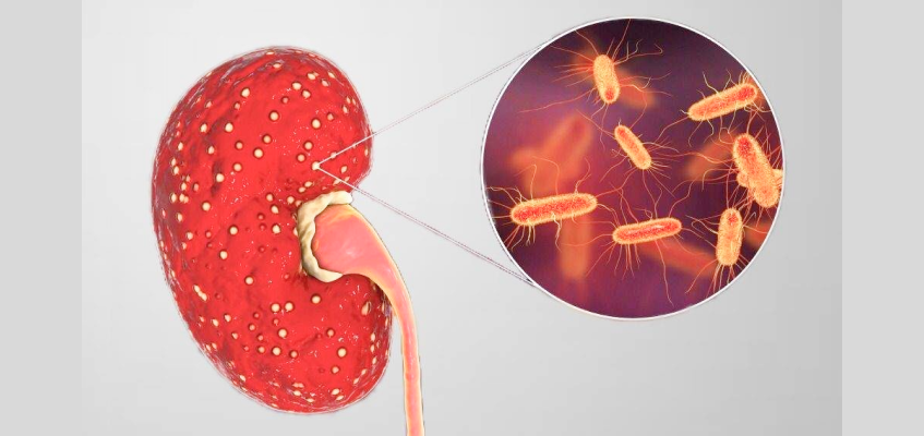 пиелонефрит